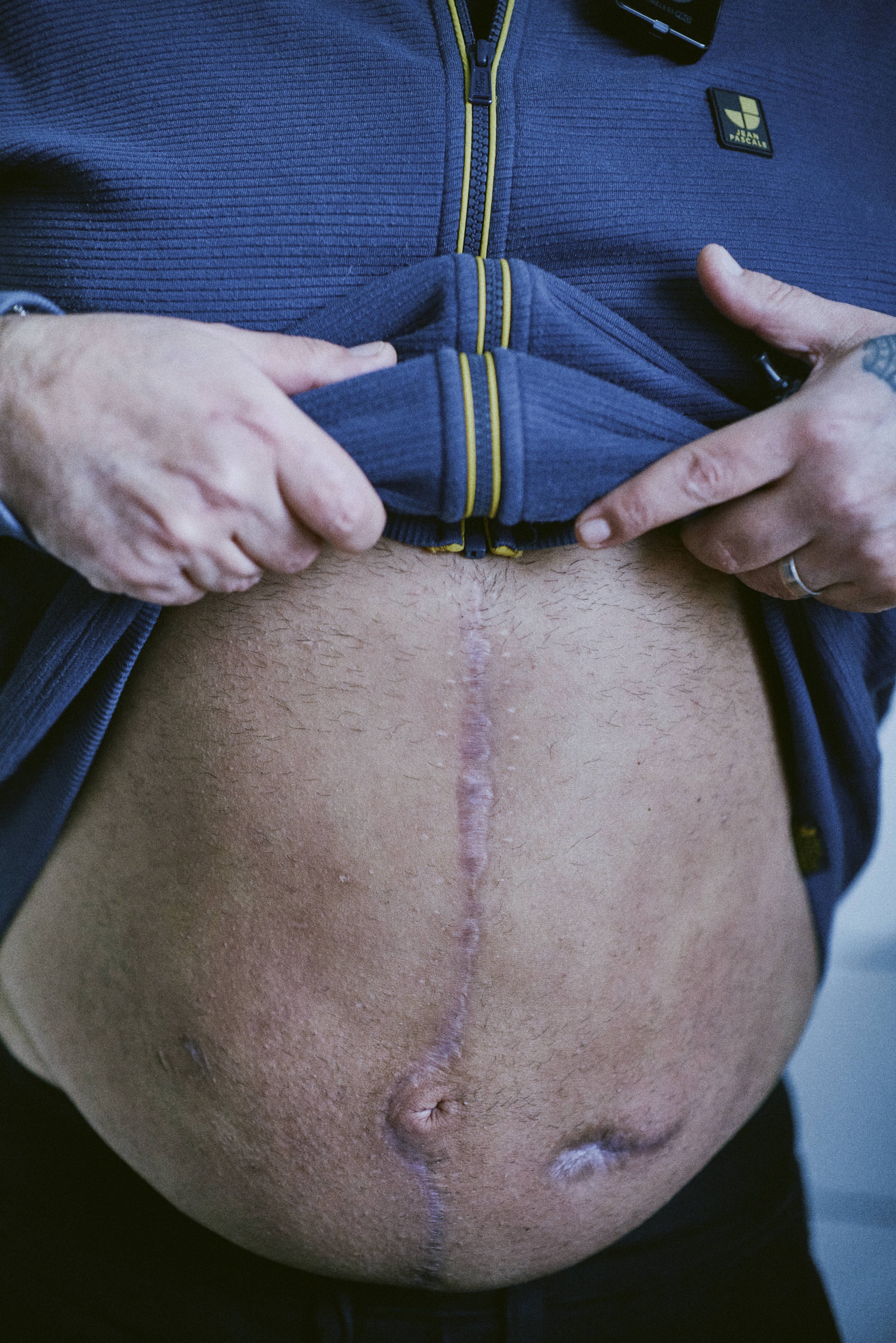 Ein Mann hebt seinen Pullover an und zeigt eine große Operationsnarbe am Bauch.